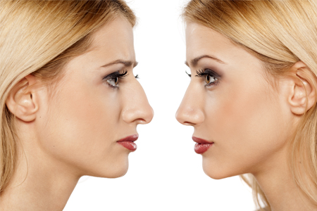 Rhinoplasty